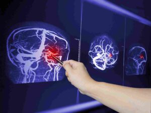 Connecticut Traumatic Brain Injury Attorney